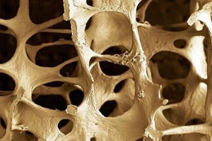 Osteoporose e exercícios para Idosos