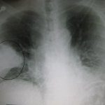 Idosos com Alzheimer tem mais risco de pneumonias.