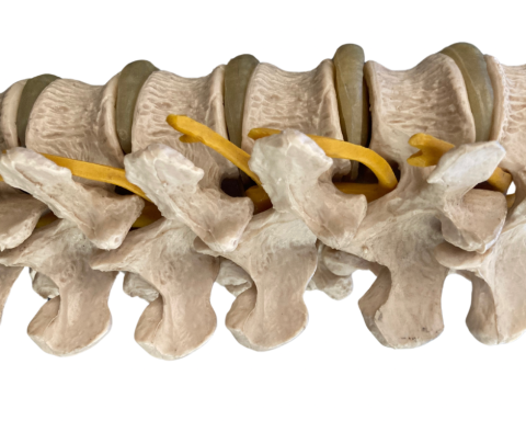 Imagem de uma coluna vertebral com hérnia de disco
